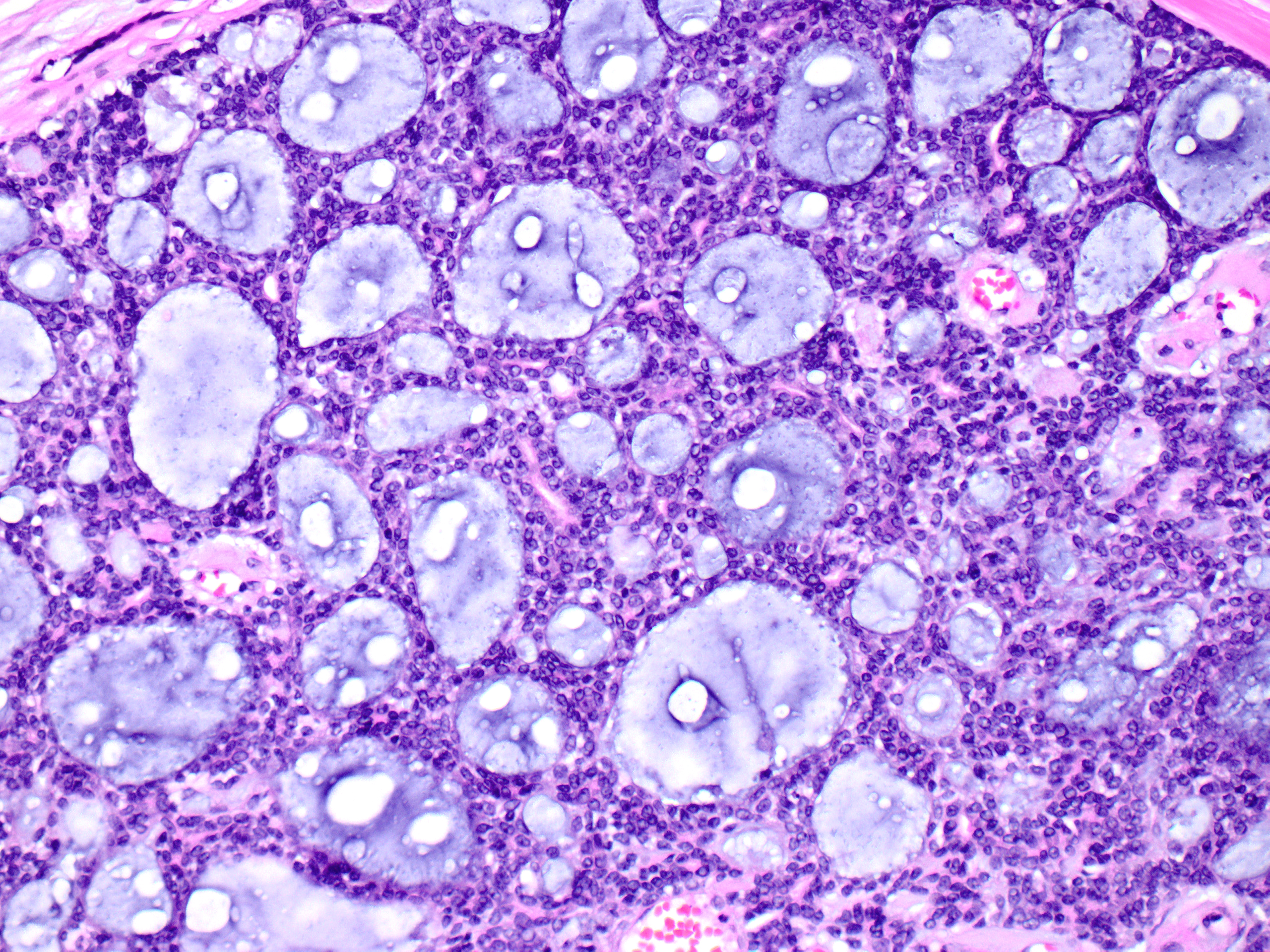 adenoid cystic carcinoma