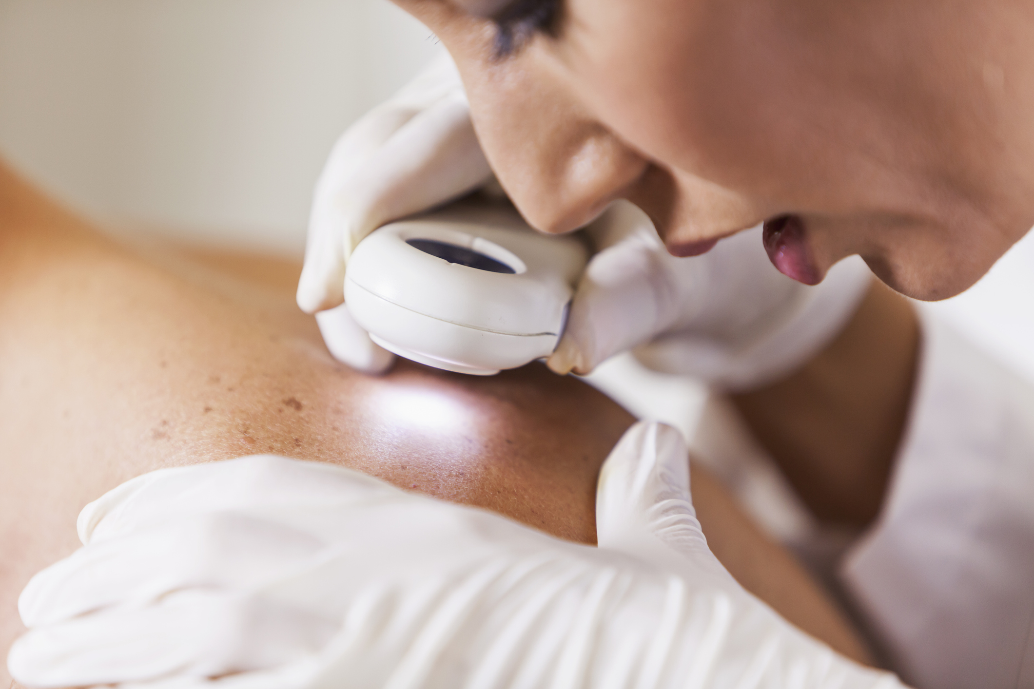 Dermatologist examining patient for signs of skin cancer - stock photo