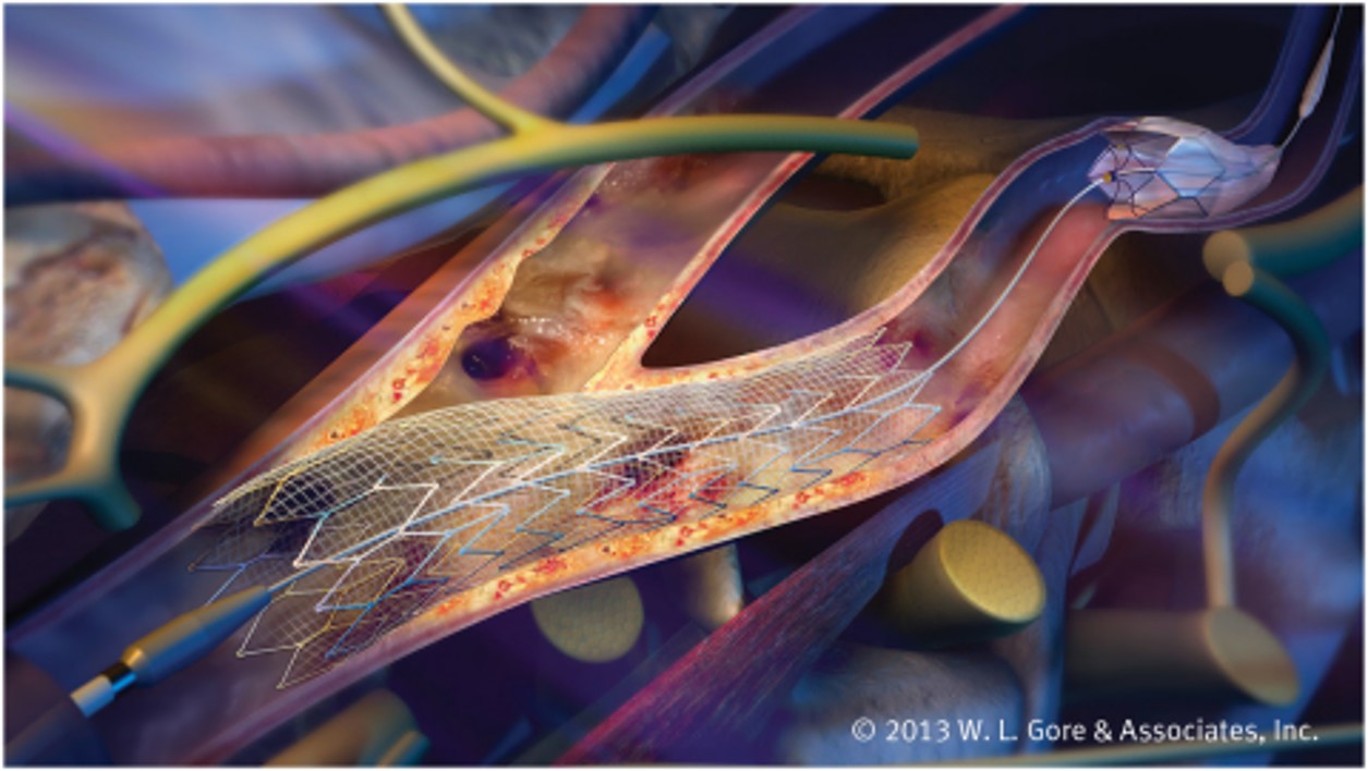 covered carotid stent