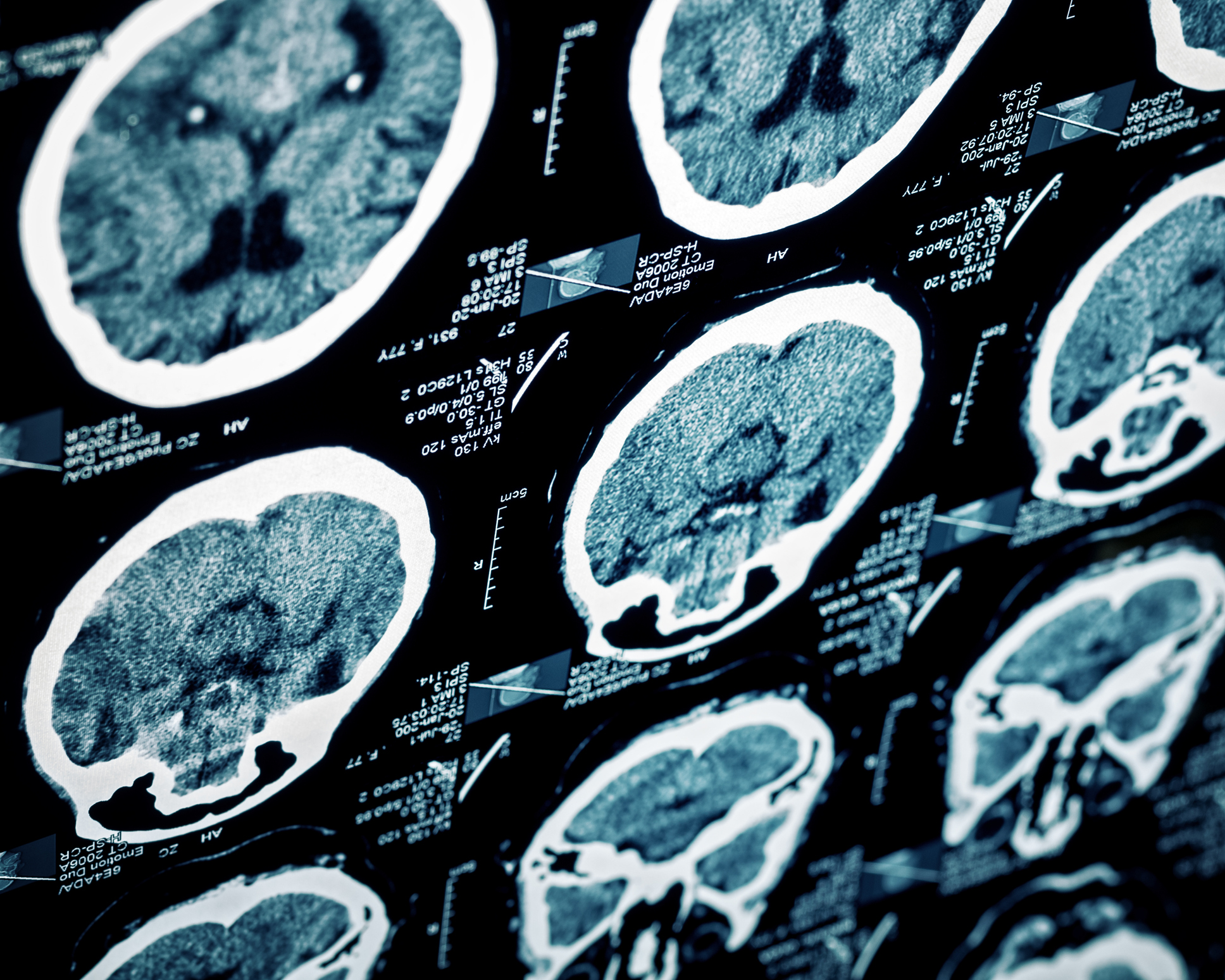 mri of brain.