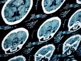 Stroke and Other Common Neurological Conditions